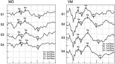 Vestibular Migraine Patients Show Lack of Habituation in Auditory Middle Latency Responses to Repetitive Stimuli: Comparison With Meniere's Disease Patients